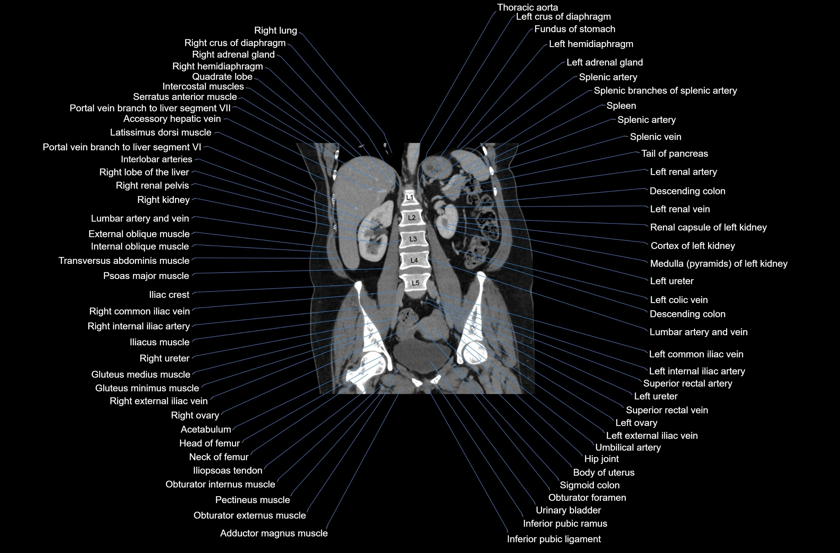 CT abdomen coronal cross sectional anatomy labelled radiology image-00052.webp